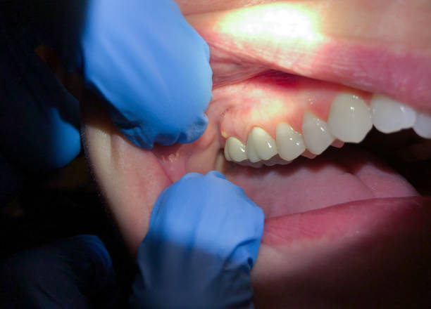 Best Emergency Tooth Extraction in Lillington, NC